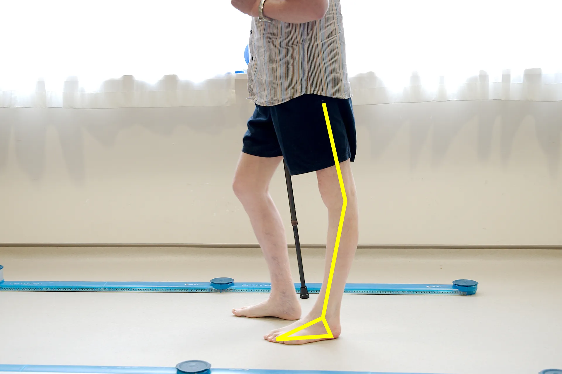 Gait Analysis 1 1